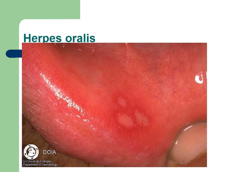 Herpes oralis